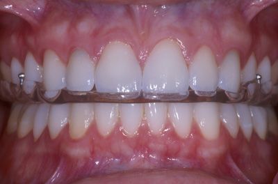 Bite Dentale: cos’è, a cosa serve? Bite Dentale: cos’è, a cosa serve?