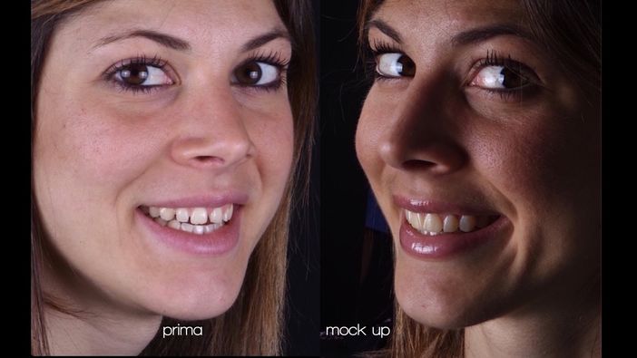 Mock Up Dentale: prototipo estetico del nuovo sorriso Mock Up Dentale: prototipo estetico del nuovo sorriso