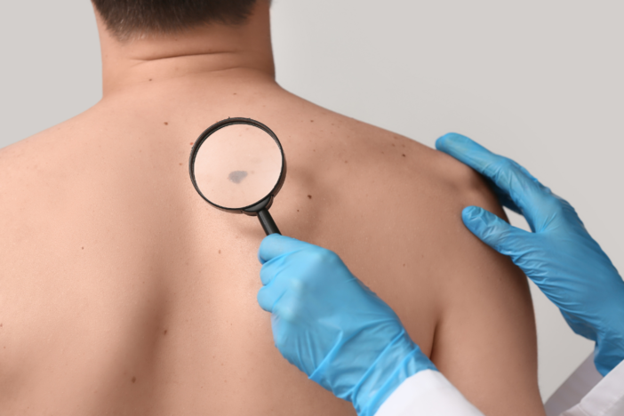 Giornata Europea del Melanoma: le linee guida per la prevenzione