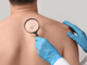 Giornata Europea del Melanoma: le linee guida per la prevenzione Giornata Europea del Melanoma: le linee guida per la prevenzione