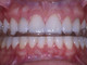 Bite Dentale: cos’è, a cosa serve?