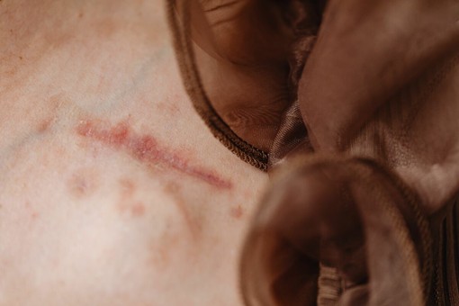 Lite a Cossato, donna cade e resta ferita a una gamba, foto pexels