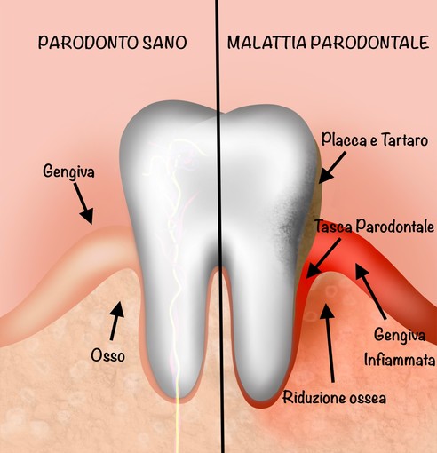 La Parodontite, come prevenirla e curarla. Da FM Dental si può