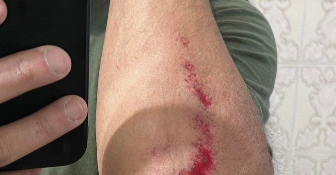 Runner rischia di essere travolto da un'auto, il racconto: “Ho rischiato la vita”