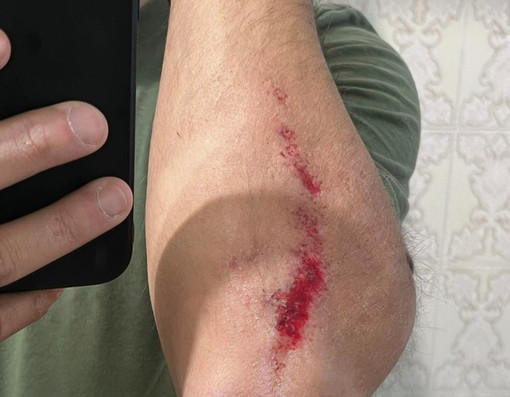 Runner rischia di essere travolto da un'auto, il racconto: “Ho rischiato la vita”