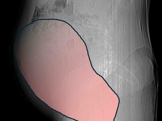 Miracolo al Sant'Anna: salvata 69enne affetta da un tumore ovarico grande come una gravidanza gemellare