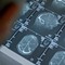 Fenilchetonuria, 'screening neonatale evita danni neurologici ma serve continuità assistenziale' Fenilchetonuria, 'screening neonatale evita danni neurologici ma serve continuità assistenziale'