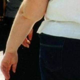 Una morte per malattie infettive su 10 è legata all'obesità, lo studio