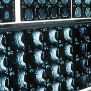 Ipofosfatemia legata all'X, primo bilancio e prospettive su linee guida Ipofosfatemia legata all'X, primo bilancio e prospettive su linee guida