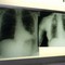 Cancro polmone, con nuova combinazione malattia sotto controllo più a lungo Cancro polmone, con nuova combinazione malattia sotto controllo più a lungo