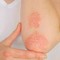 Giornata psoriasi, Ucb rinnova l'impegno contro lo stigma Giornata psoriasi, Ucb rinnova l'impegno contro lo stigma
