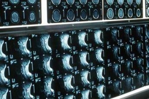 Ipofosfatemia legata all'X, primo bilancio e prospettive su linee guida Ipofosfatemia legata all'X, primo bilancio e prospettive su linee guida