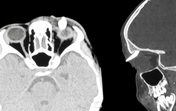 Ha un gonfiore sotto l'occhio, in ospedale scoprono che ha un dente nella palpebra: lo strano caso in India Ha un gonfiore sotto l'occhio, in ospedale scoprono che ha un dente nella palpebra: lo strano caso in India