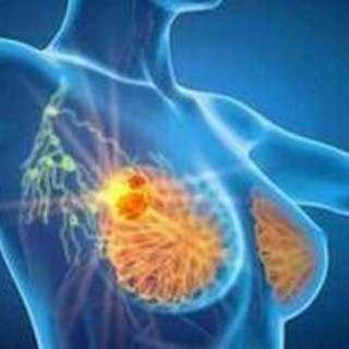 Cancro seno iniziale Her2+, con anticorpo farmaco-coniugato -53% recidiva Cancro seno iniziale Her2+, con anticorpo farmaco-coniugato -53% recidiva