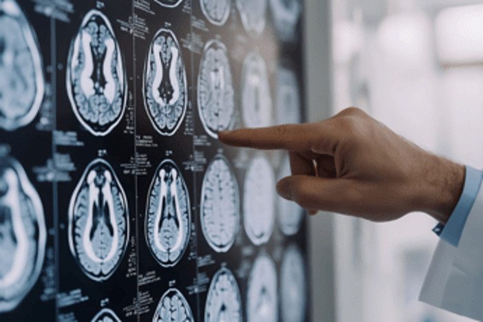 Tumori: glioma, Fda riconosce come farmaco orfano l'isotopo rame-64 sviluppato nelle Marche