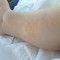 Dermatite atopica, Aifa estende rimborso di upadacitinib dai 12 anni di età Dermatite atopica, Aifa estende rimborso di upadacitinib dai 12 anni di età
